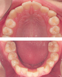 Zahnvergleich - Fall 1 - Vorher