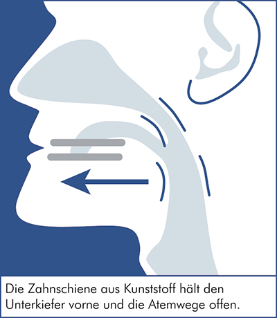 Beschreibung der Schnarcherschiene